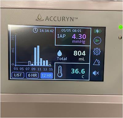 Automated Intra-abdominal Pressure Monitoring During Orthotopic Heart Transplant Leads to Early Diagnosis and Treatment of Intraoperative Abdominal Compartment Syndrome—A Case Report